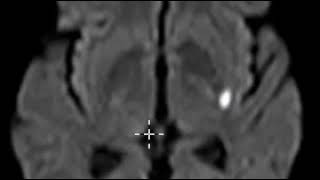 Acute lacunar infarction basal ganglia [upl. by Askari]