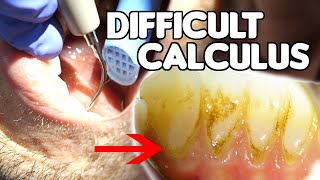 How To Remove Difficult amp Tenacious Calculus Tartar [upl. by Ecela]