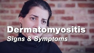 Dermatomyositis – Signs amp Symptoms  Johns Hopkins [upl. by Tudor]