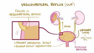 VIDEO Acute pyelonephritis urinary tract infection causes symptoms amp pathology [upl. by Fredie]