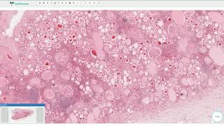 Chronic Pyelonephritis  Kidney Histopathology [upl. by Lelia]