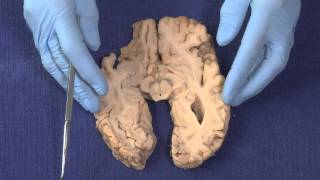 Basal Ganglia Neuroanatomy Video Lab  Brain Dissections [upl. by Culosio186]