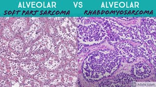 Alveolar Soft Part Sarcoma vs Alveolar Rhabdomyosarcoma [upl. by Tterej]