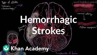 Hemorrhagic strokes  Circulatory System and Disease  NCLEXRN  Khan Academy [upl. by Ahsinid]