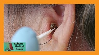 Chunky Earwax Removal  Auburn Medical Group [upl. by Soelch]