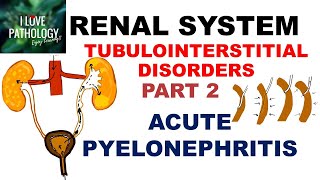 ACUTE PYELONEPHRITIS Pathology [upl. by Tiossem]