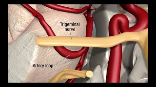 Treatment for Trigeminal Neuralgia UCSF Neurosurgery [upl. by Farkas]