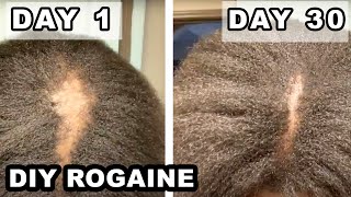 How I fixed my BALD SPOT  DIY Rogaine on 4C Natural Hair [upl. by Seidler]