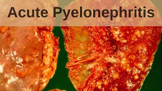 Acute pyelonephritis  Pathology mini tutorial [upl. by Jenica]