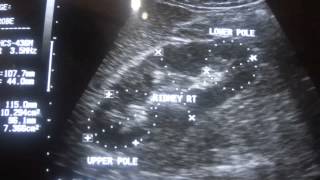 ULTRASOUND PYELONEPHRITIS acute part 1 [upl. by Ariayek]