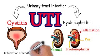 Cystitis  made simply UTI Cystitis vs pyelonephritis [upl. by Aitnwahs]